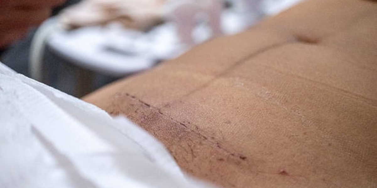 Affordable Laser Scar Removal in Dubai Clinics
