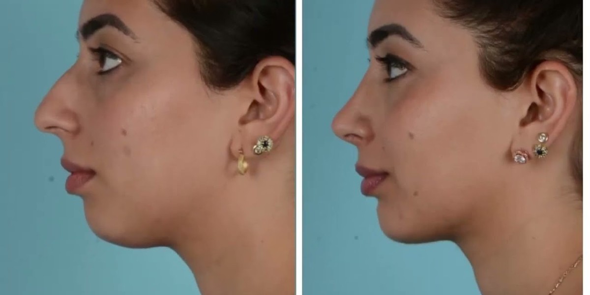 كيف أثرت عملية تصغير الذقن على ثقة مرضانا بأنفس