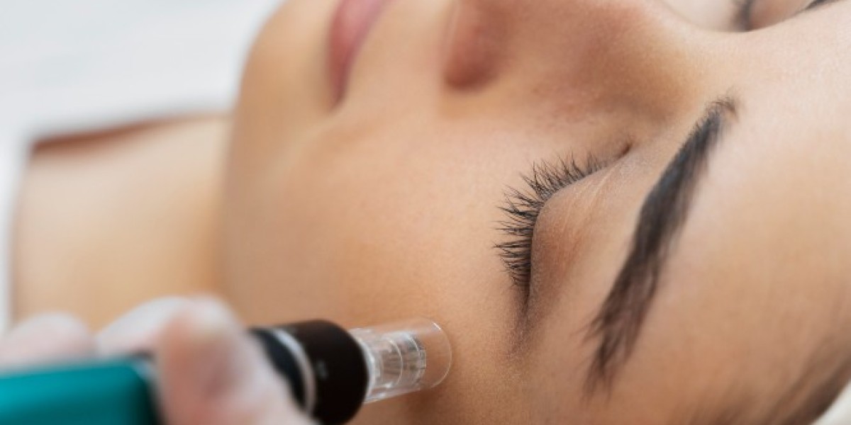 How Microneedling Can Help You Look Younger