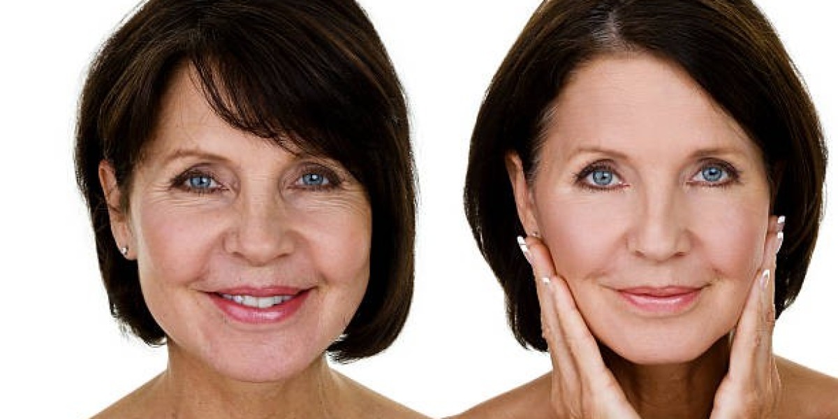 Achieve Lifted Skin with Facelift in Riyadh