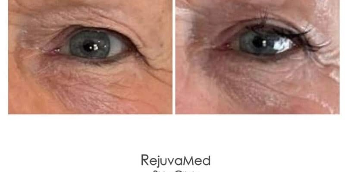 Discover a Refreshed Look with Affordable Upper
