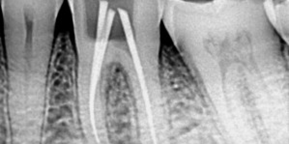 Root Canal Treatments in Ahmedabad: Everything