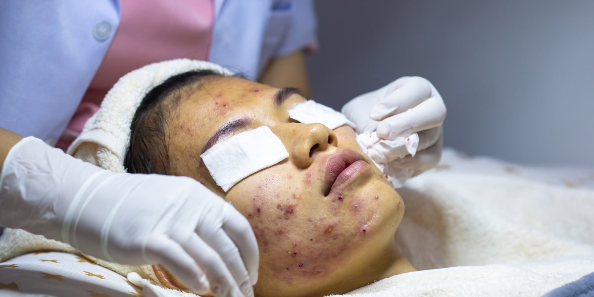 Clear Skin Naturally: Exploring the Best Method
