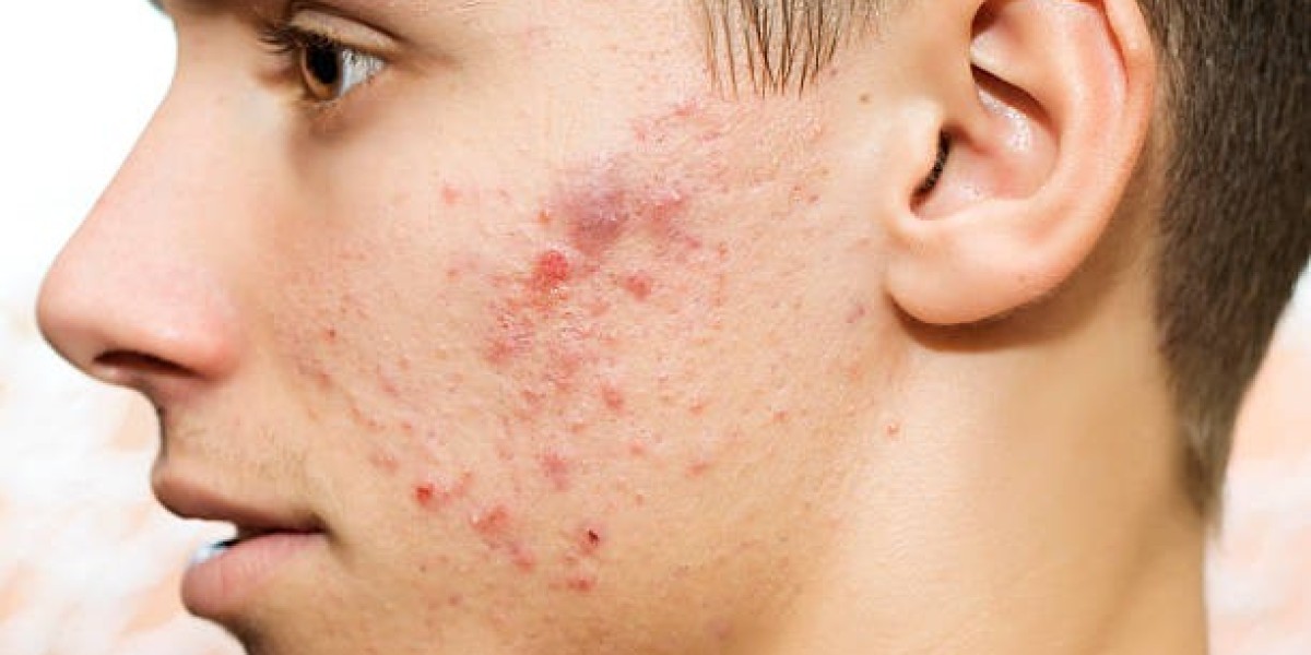 Pimples Treatment in Dubai: Women’s Skincare