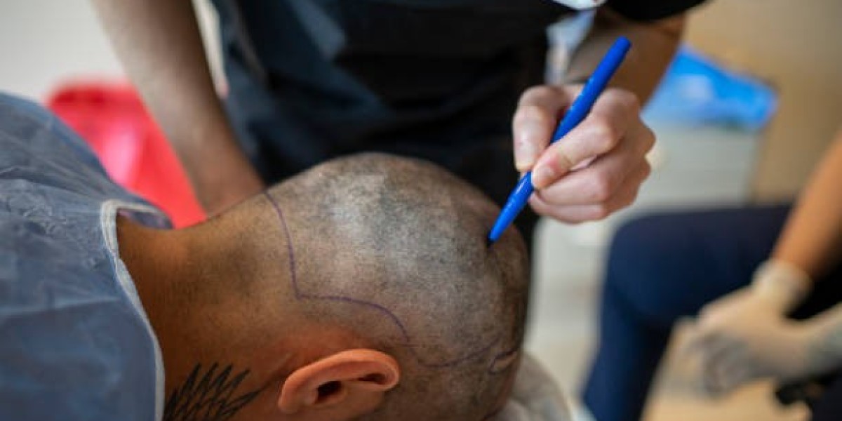 How Safe Are Hair Transplants in Dubai?