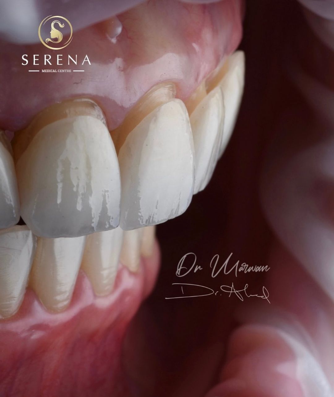 Hollywood Smile with Dental Veneers and Lumineers in Dubai