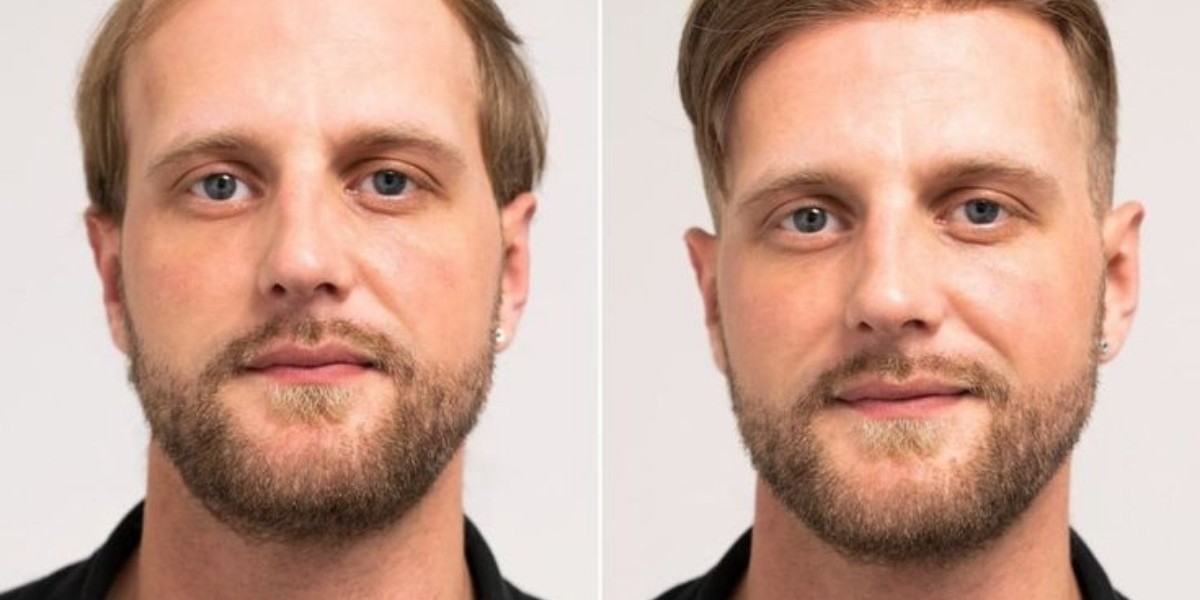 Men’s Hair System: A Non-Surgical Solution to H