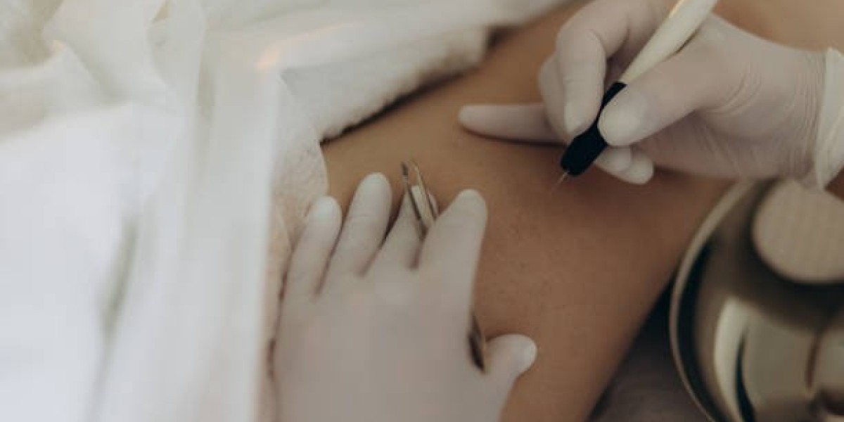 Electrolysis Hair Removal in Dubai: The Future