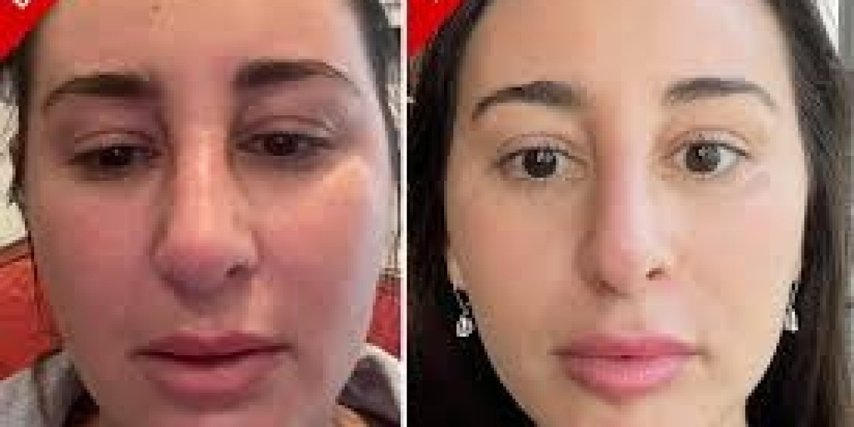 Understanding the ‘Ozempic Face’: What Happens