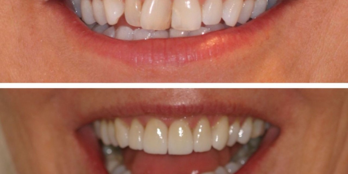 Affordable teeth aligners price in Pakistan.