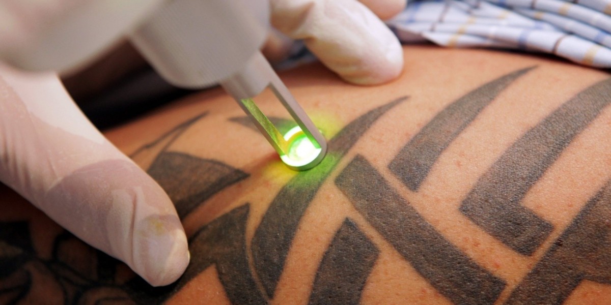 Tattoo Removal Market 3031: Trends