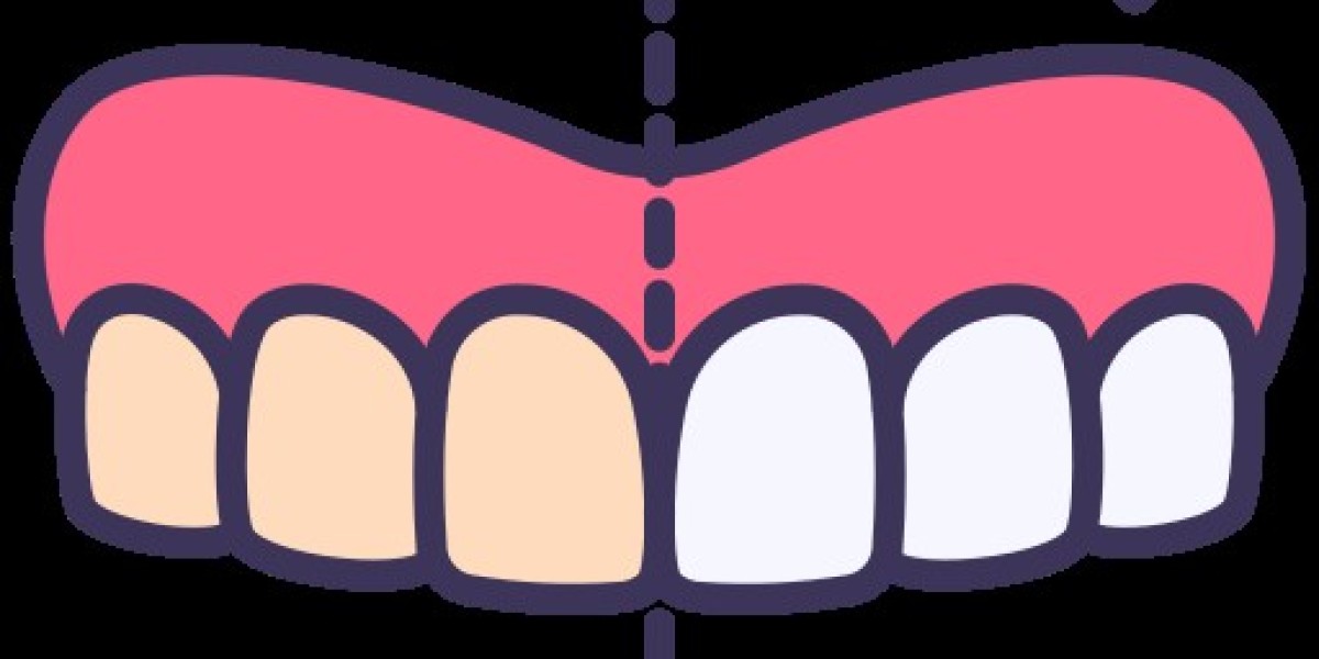 Teeth Whitening: A Guide to a Brighter Smile