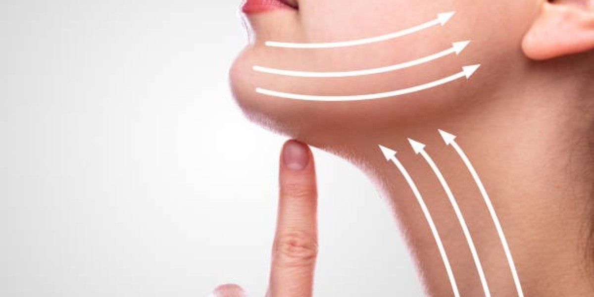 Facelift Before and After: Real Patient