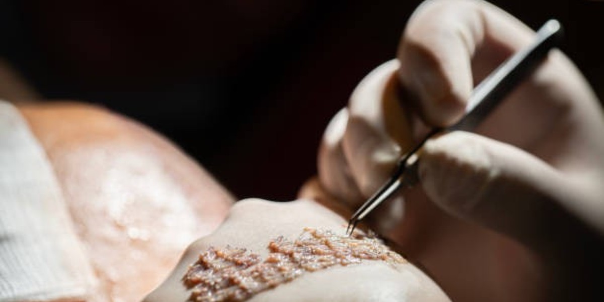 Hair Transplant Cost in Dubai: Your Financial