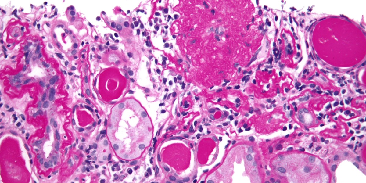 Navigating Kidney Health: A Guide to C3G Treatm