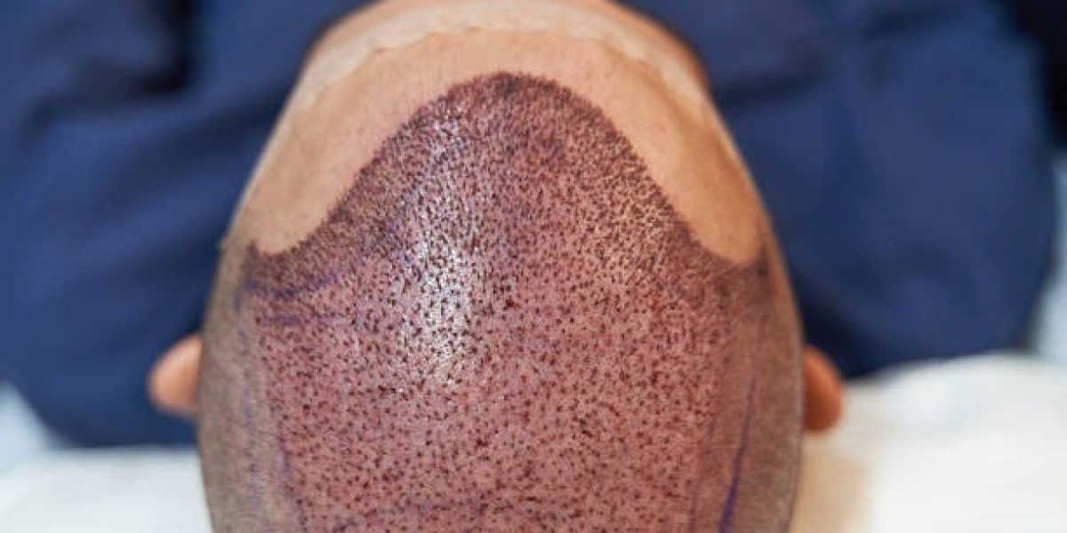 Hair Transplant in Riyadh: Advanced Techniques,