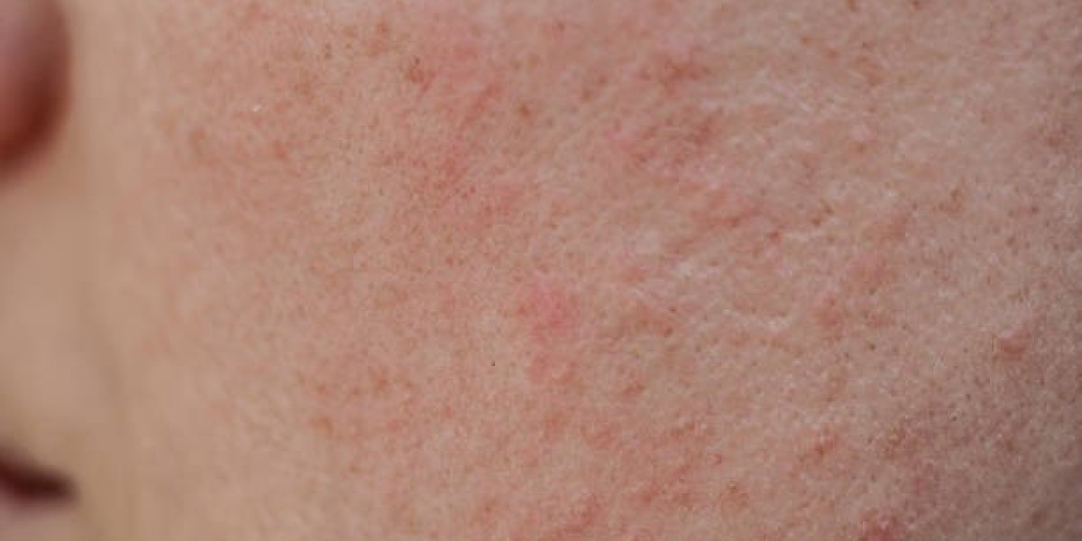 Large Pores Treatment: Happy Skin Days