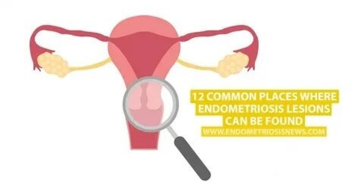 Find the Right Endometriosis Specialist in Aust