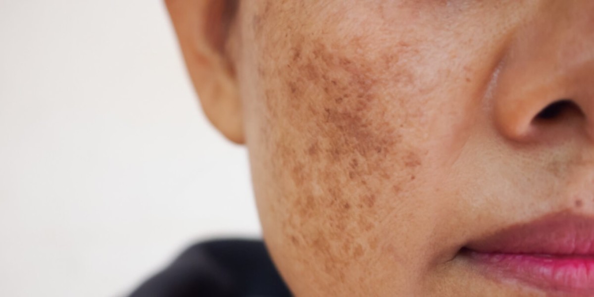 Melasma in Men:Is It Different&How is it Treat?