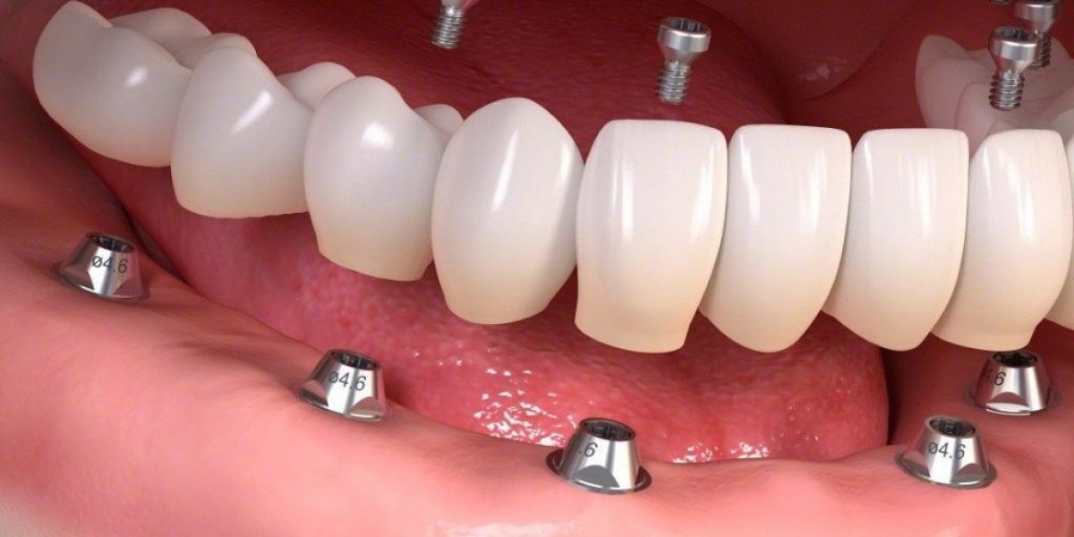 Smile Brighter for Less with Dental Implants Al