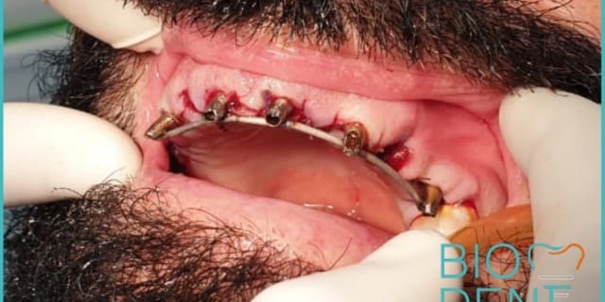 L’Eccellenza degli Impianti Dentali Albania per