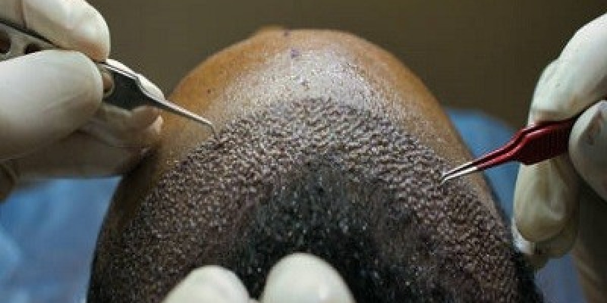 Will My Hair Transplant Look Natural?