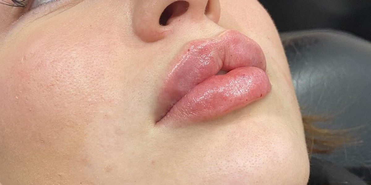 IPL Skin Rejuvenation in Melbourne