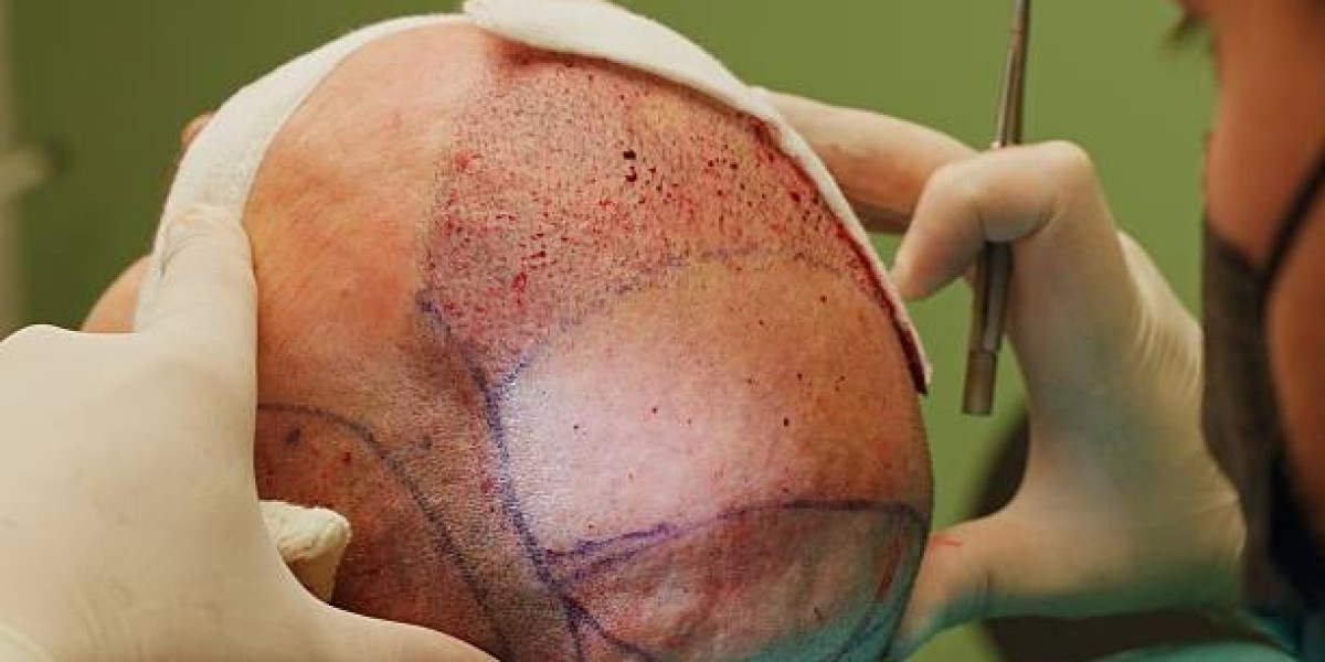 Hair Transplant Cost in Dubai: Planning Ahead