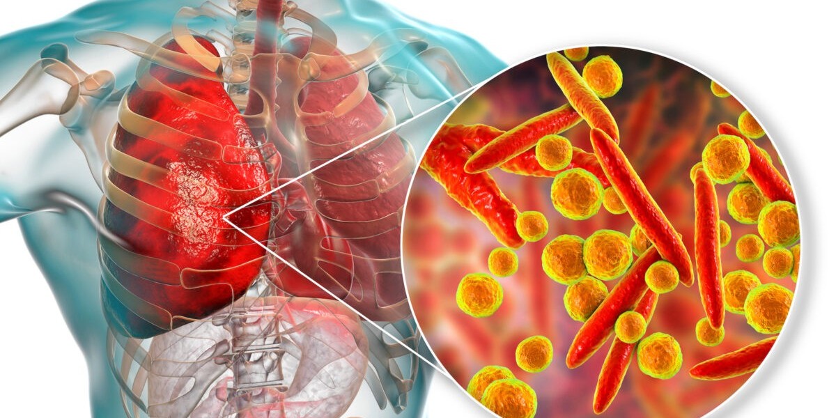 Pneumonia Therapeutics Market: Trends Shaping