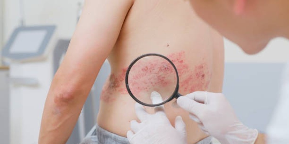 تعرف على علاج الحزام الناري من خلال الصور والنص