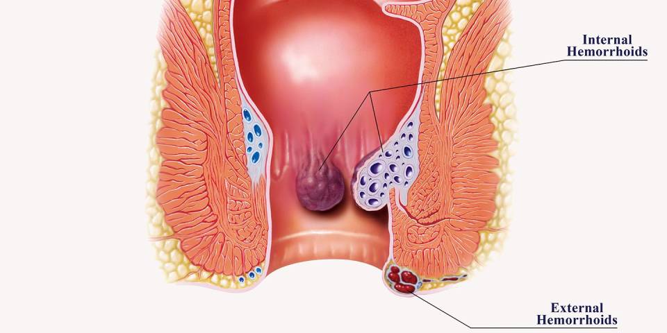 Best Piles Specialist in Chennai - Dr. Pinak Dasgupta: Expertise and Personalized Treatment