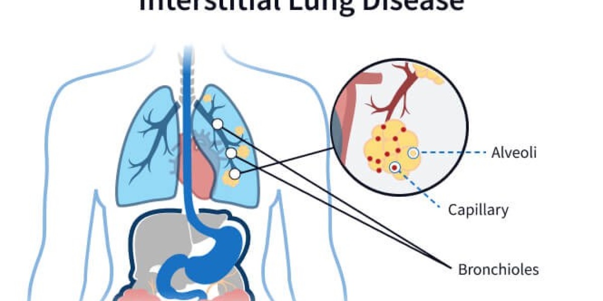 Living with Interstitial Lung Disease