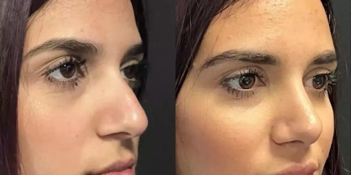 Best Doctors in Dubai Nose Deviated Correction