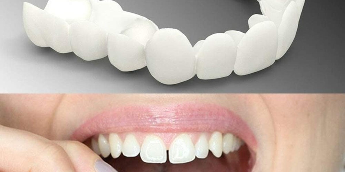 Redéfinir votre sourire avec les facettes denta