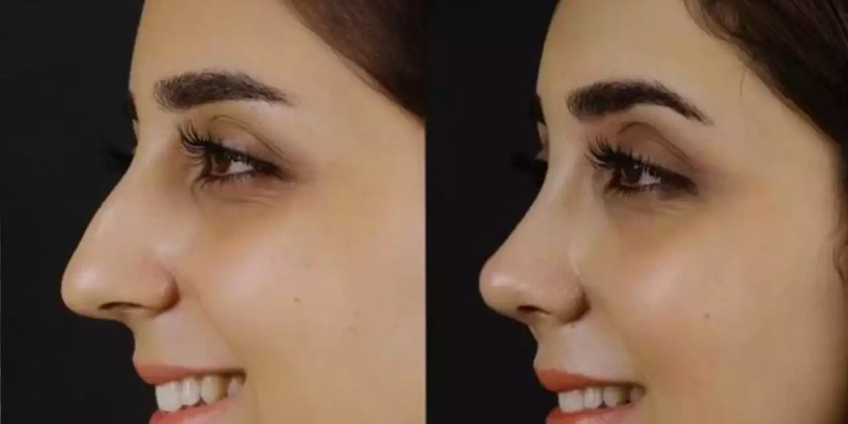Heal with Best Septoplasty Surgeons in Dubai